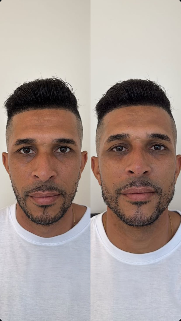 Antes e depois de definição de mandíbula com a Dra. Giovanna Brito