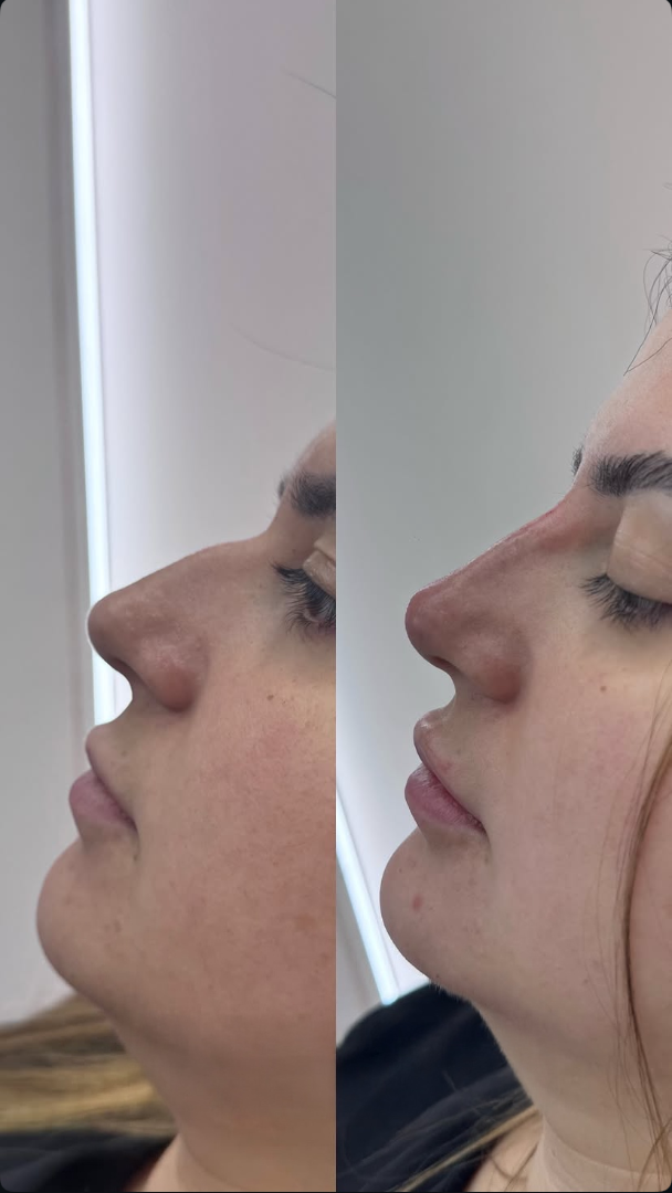 Antes e depois de preenchimento de mento perfil equilibrado