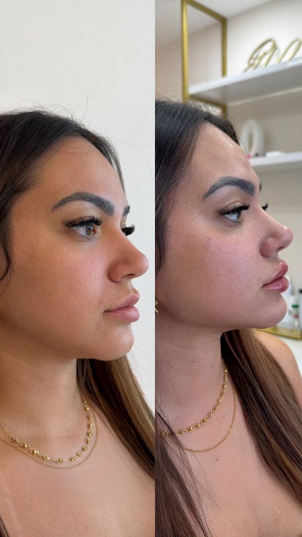 Antes e depois de harmonização facial terço inferior equilibrado