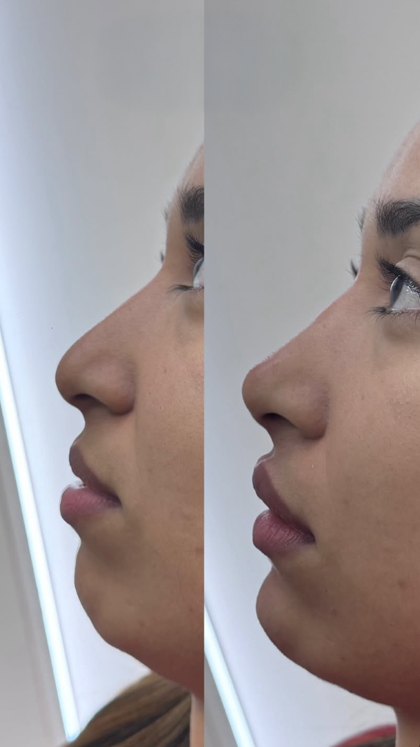 Antes e depois de preenchimento labial contorno definido e natural