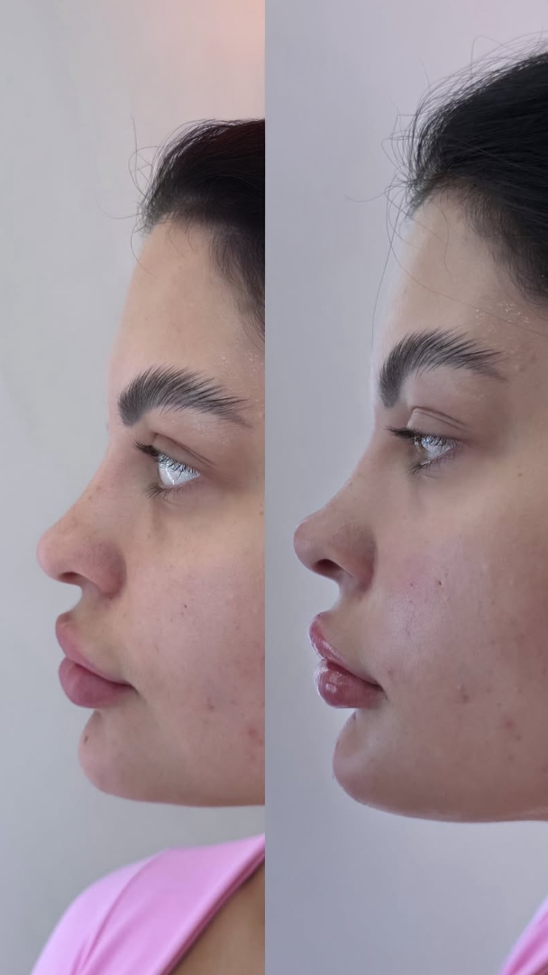 Antes e depois de rinomodelação e lábios perfil harmonizado